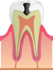C2:歯の内面の虫歯